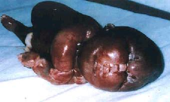 Recem-nascido no Iraque.  Os crimes nefandos do imperialismo americano afectam as gera��es futuras.